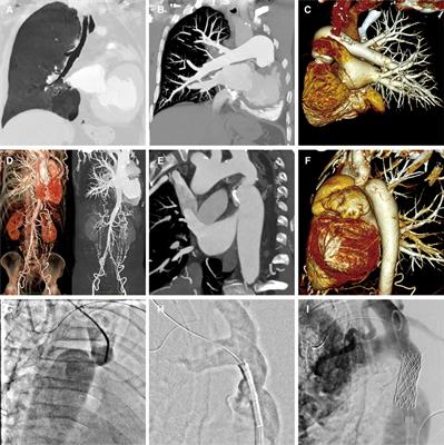 Case Report: Transcatheter treatment of aortic coarctation in a 58-year-old patient with LACHT syndrome and left lung agenesis
